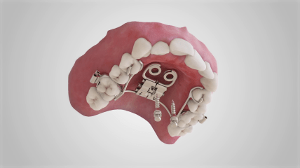 tomas® Verankerungssysteme - tomas® Pin-Last Konzept mit RPE eyelet