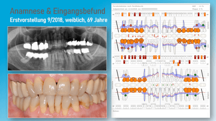 AG DDM Praxispreis 2024 „Darstellung eines lokalen Parodontitisrezidivs“