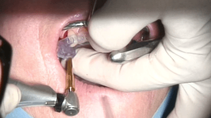 Minimalinvasiv und digital: Implantation mit Sofortversorgung