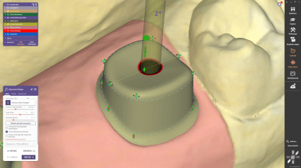 Flexible Fissurenlinie für präzises, individuelles Abutment-Design