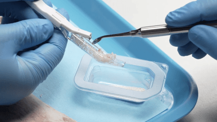 Bone Scraper von Camlog – Einfache Entnahme autologer kortikaler Knochenspäne