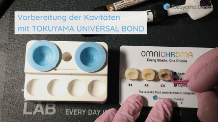 Anwendungsbeispiel: OMNICHROMA von TOKUYAMA DENTAL