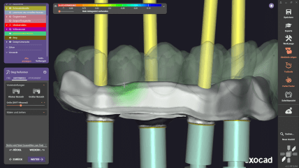 exocad DentalCAD 3.3 Chemnitz: Free from bar