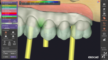 exocad DentalCAD 3.3 Chemnitz: Free forming anatomy
