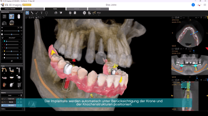 KI-gestützte Implantatplanung mit Carestream